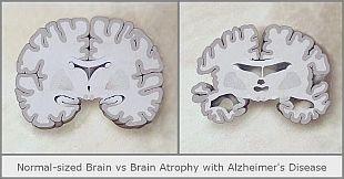 normal-sized brain vs brain atrophy with Alzheimer's disease