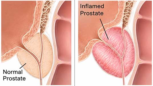 Normal versus inflamed prostate